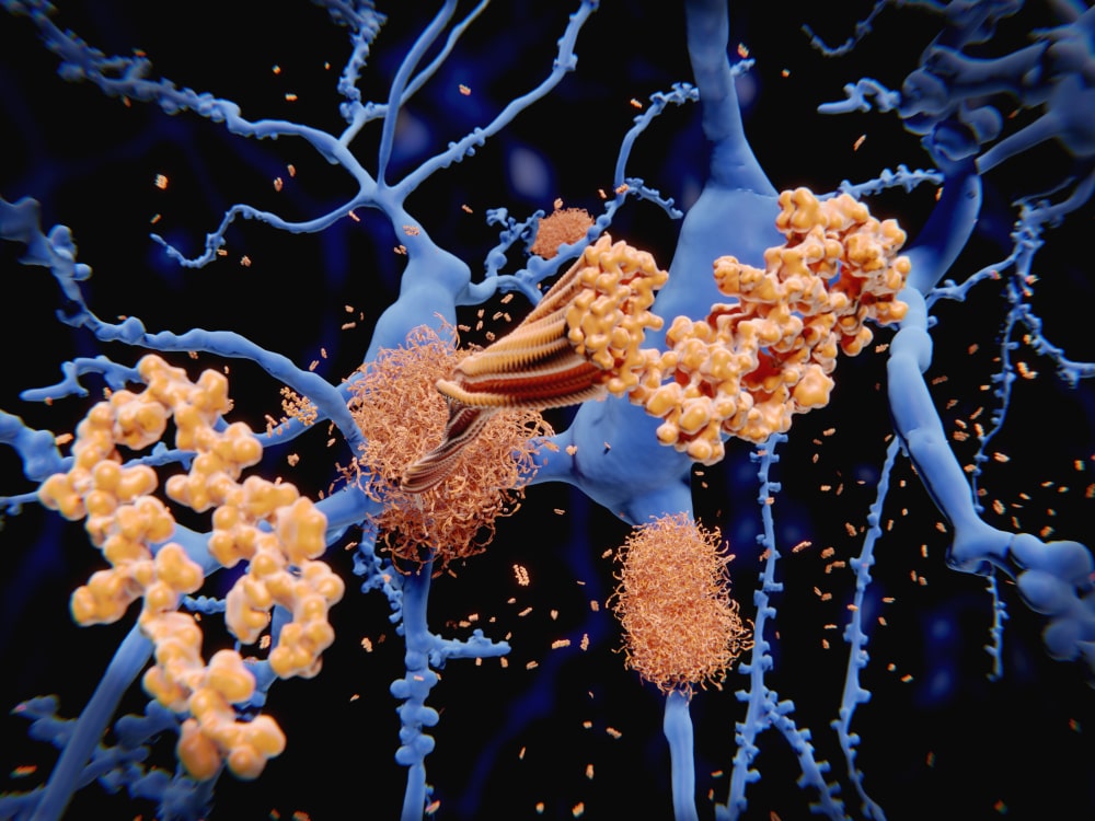 L’Alzheimer potrebbe avere diverse varianti, ognuna associata a una differente combinazione di proteine presenti nel fluido che avvolge il cervello.