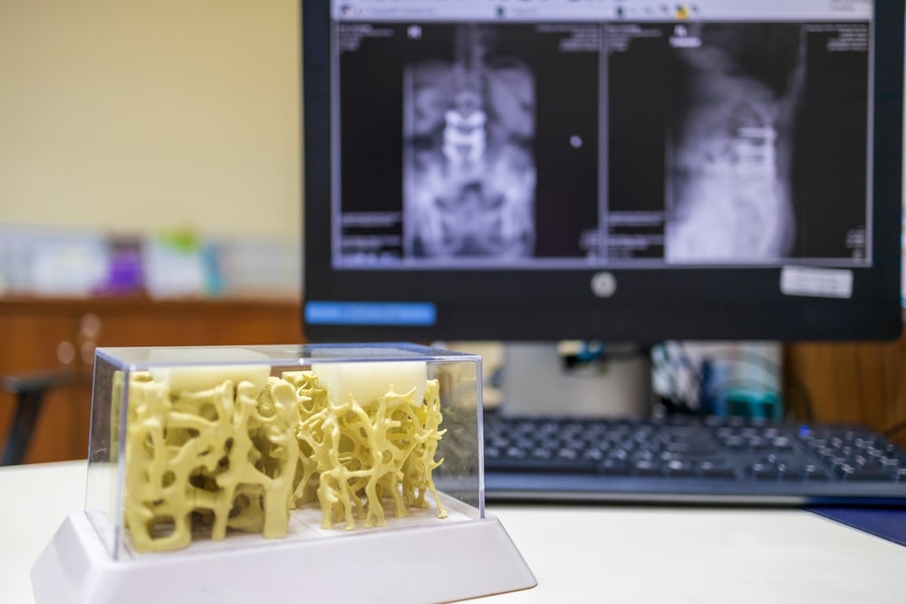 Osteoporosi severa il farmaco abaloparatide ora rimborsato dal Servizio Sanitario Nazionale