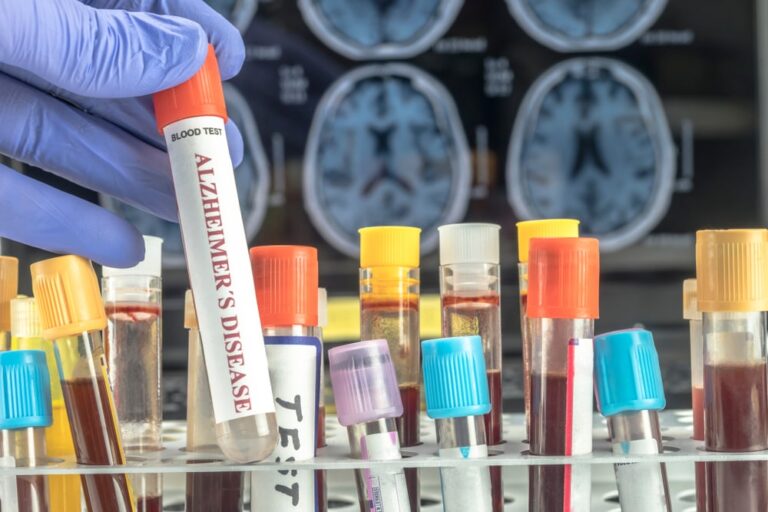 Alzheimer, primo test del sangue per diagnosi semplici e precoci