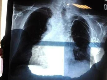 Cancro polmone, nuova terapia orale riduce del 44% il rischio di morte