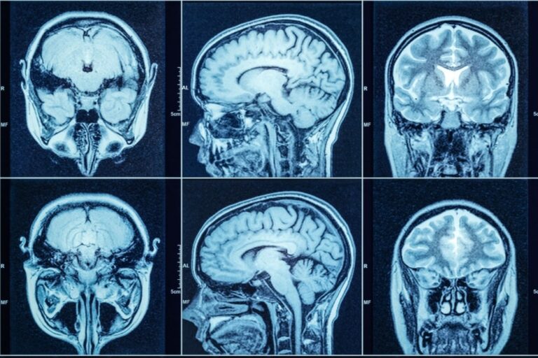 Disturbi della memoria, così il cervello conserva ricordi simili