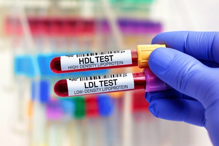 Eccesso di colesterolo, nuove prospettive di cura dall’epigenetica