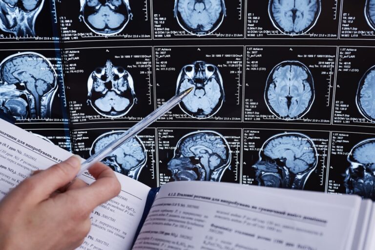Late, la demenza che si confonde con l’Alzheimer
