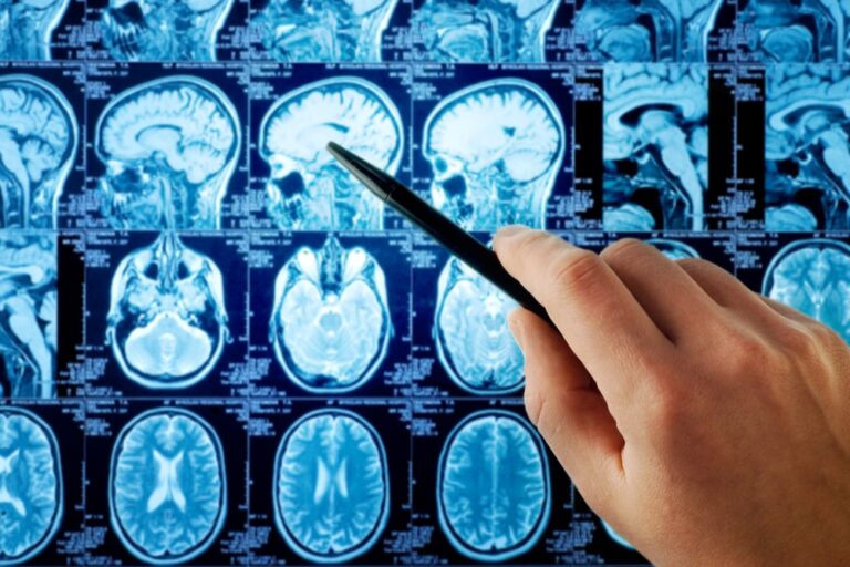Le cause dell’Alzheimer: un nuovo studio cerca di fare chiarezza