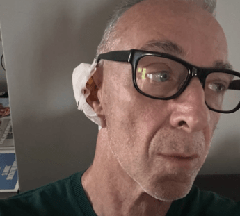 Linus ha una malattia della pelle: “Si chiama Epitelioma”. Di cosa si tratta