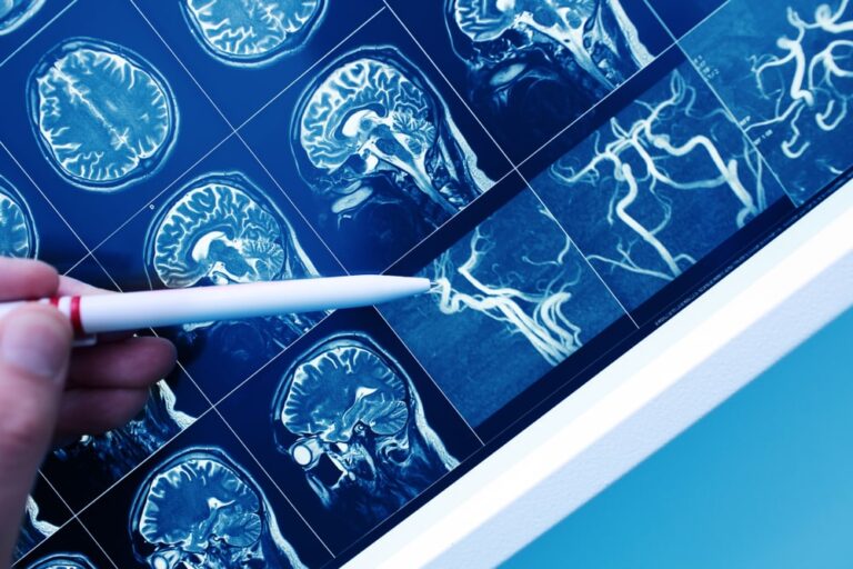 Nel 15% dei casi l’Alzheimer è genetico, lo studio spagnolo