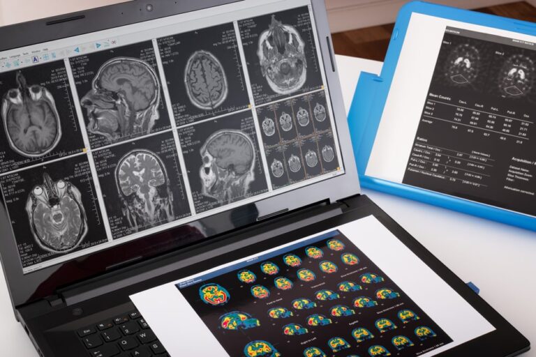 Prevenire il Parkinson si può? L’intervista al Professor Antonini