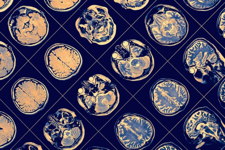 Il nuovo test per il Parkinson, dall’analisi della saliva la diagnosi precoce
