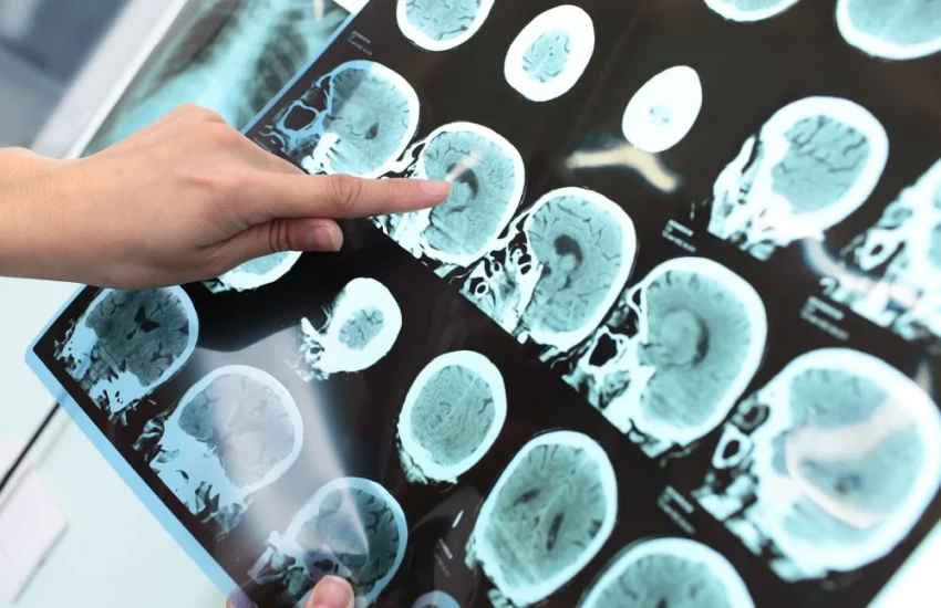 Alzheimer, la malattia inizia 18 anni prima dei sintomi cognitivi